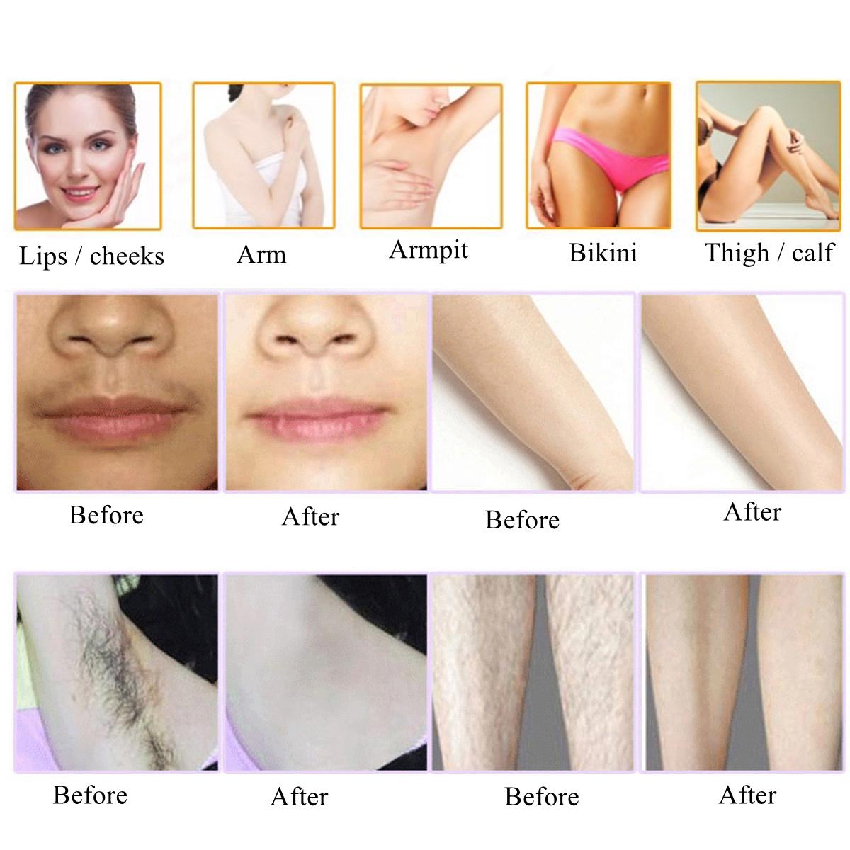 IGOODSKIN@IPL Hair Removal Handset