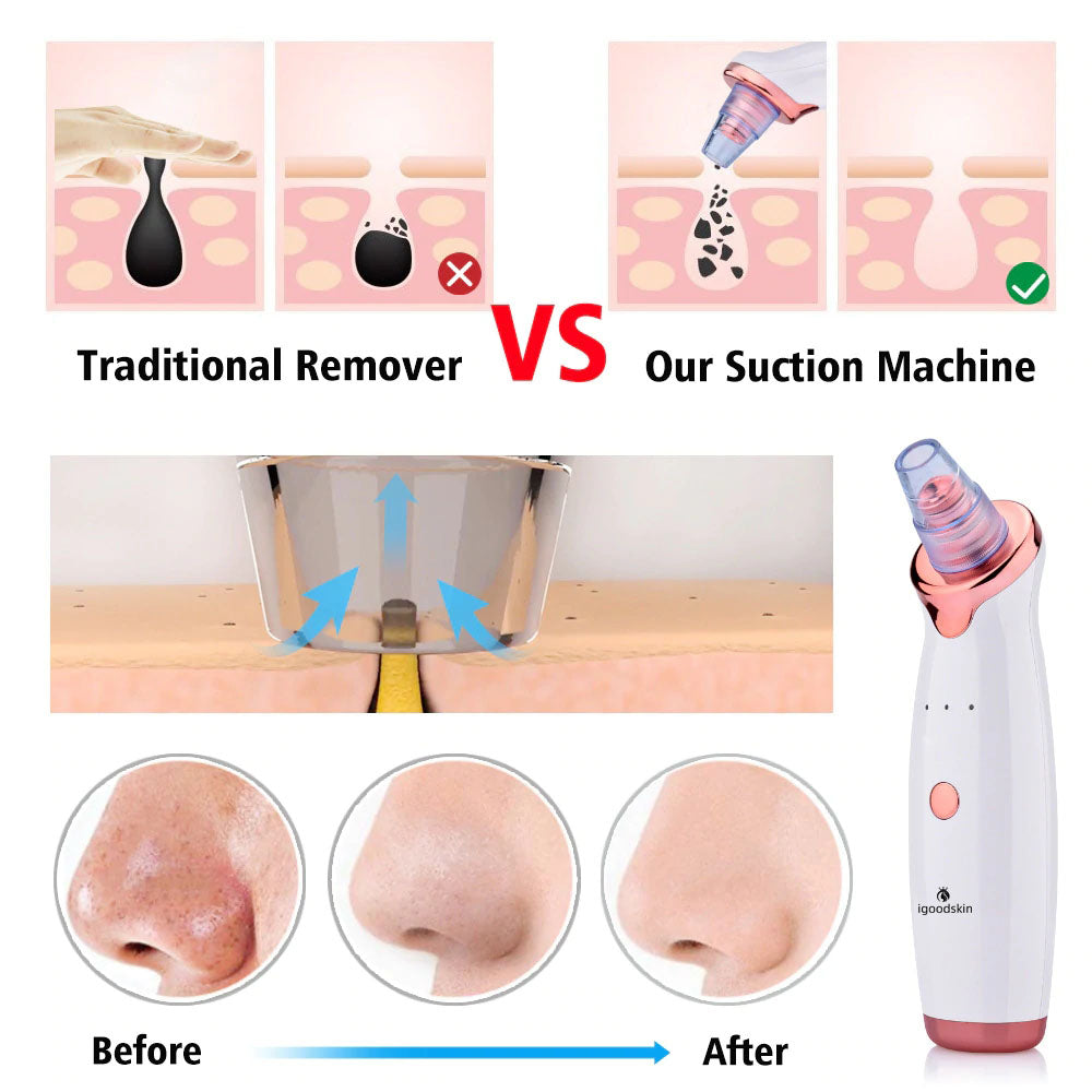 IGOODSKIN@-Original Blackhead Remover Pore Vacuum